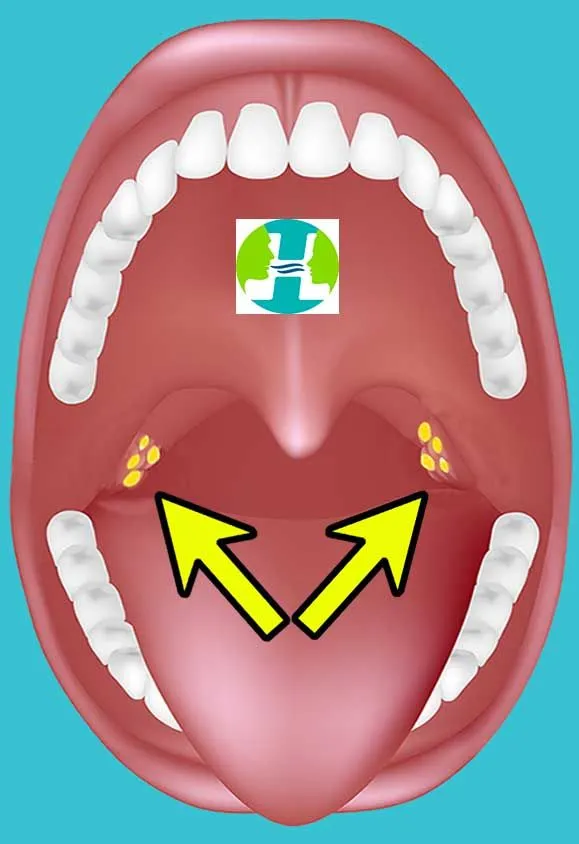 Caseum: bolinha branca na garganta. Causas, prevenção e como