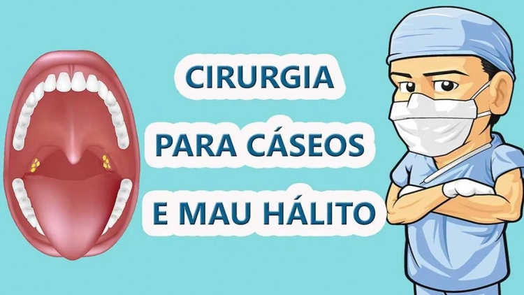 Cáseos: o que são as bolinhas e como tratar?