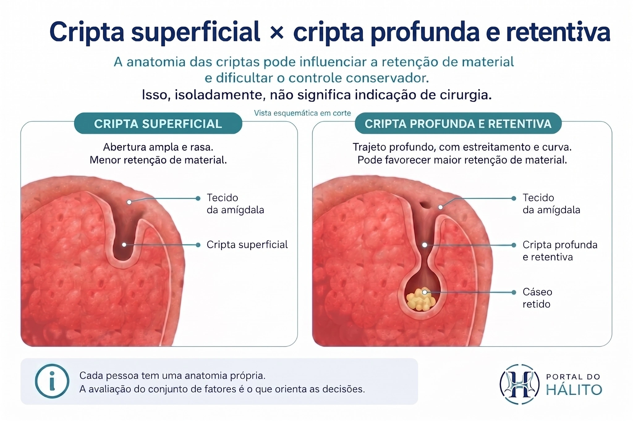 Comparação esquemática em corte entre uma cripta amigdalar superficial e uma cripta profunda e retentiva com cáseo retido no fundo.
