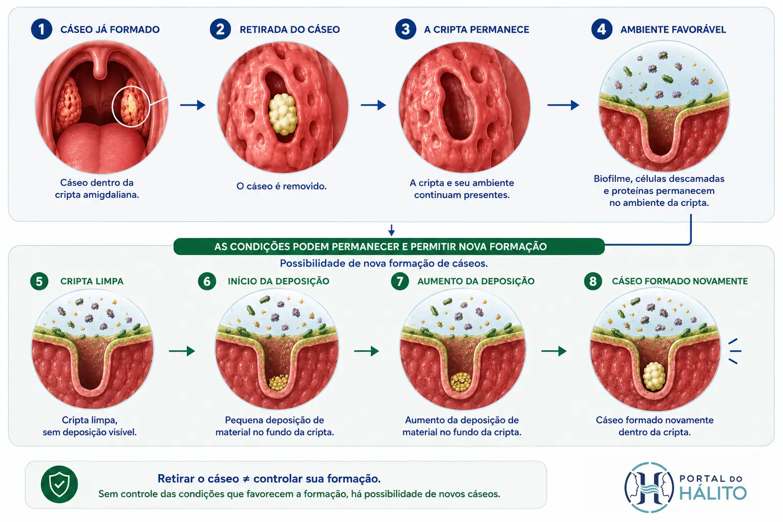 Infográfico em etapas mostrando um cáseo na cripta amigdaliana, sua retirada, a permanência da cripta e do ambiente com biofilme e proteínas e a possibilidade de nova formação.