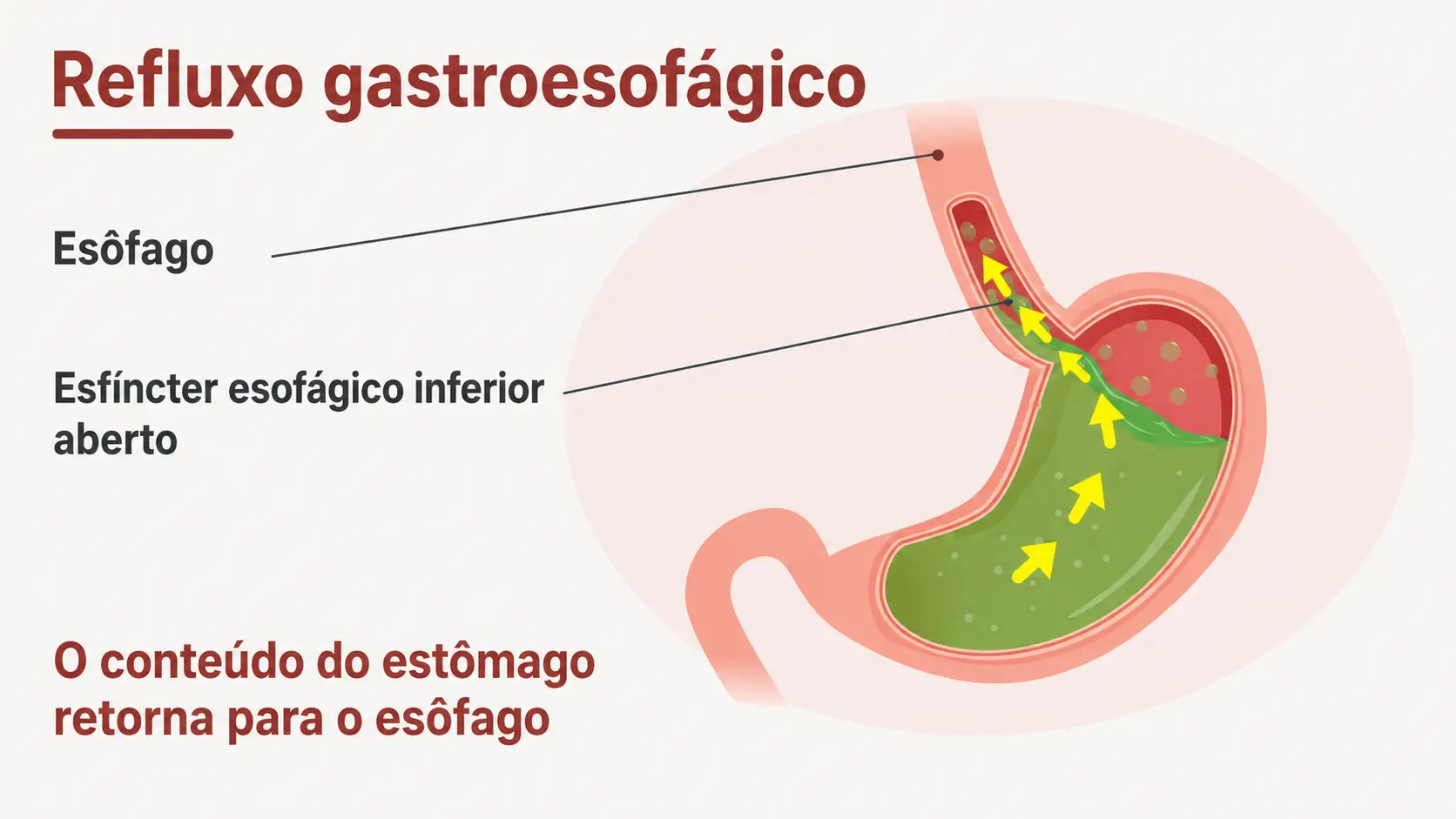 Diagrama de refluxo gastroesofágico, com o esfíncter esofágico inferior aberto e setas indicando o retorno do conteúdo do estômago para o esôfago.