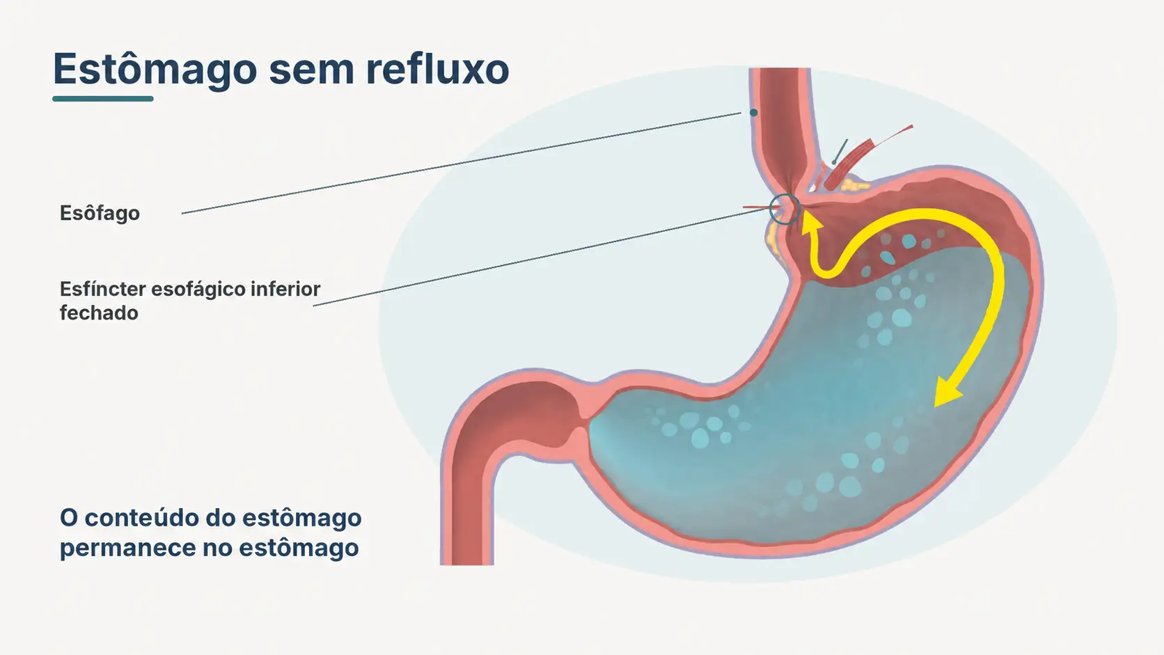 Diagrama de estômago sem refluxo, com o esfíncter esofágico inferior fechado e setas indicando o conteúdo permanecendo no estômago.