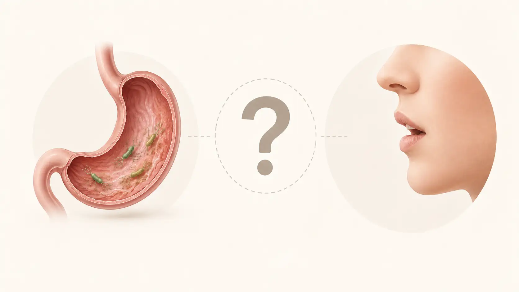 Ilustração de estômago com H. pylori e boca separados por um ponto de interrogação, indicando que associação não comprova causalidade.