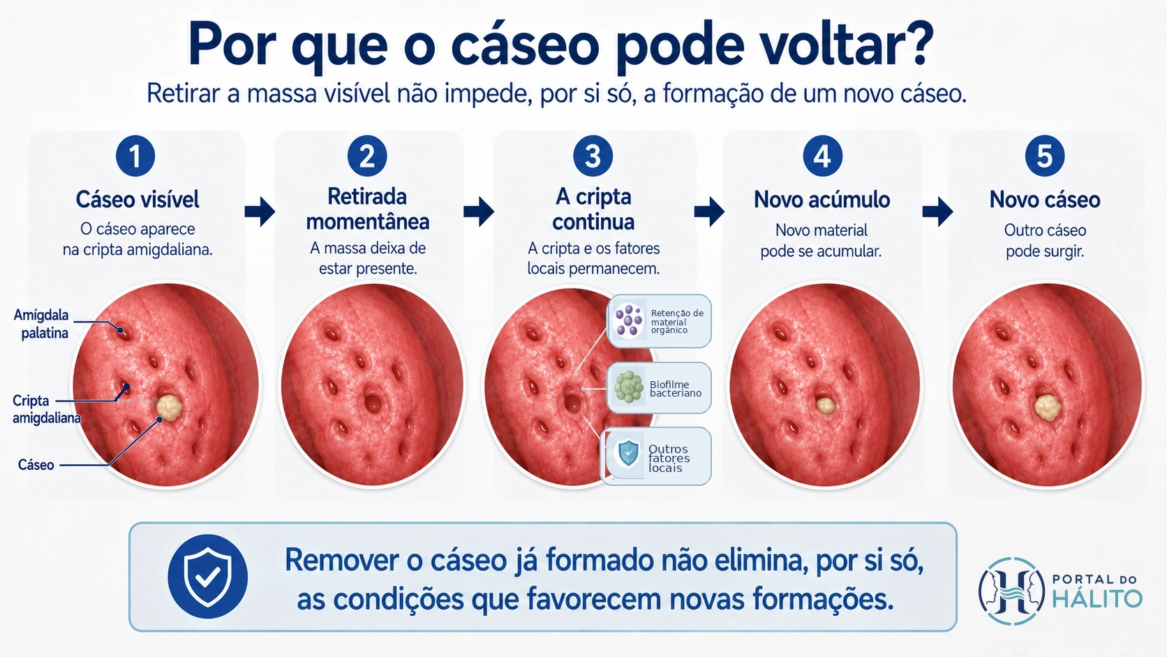 Infográfico em cinco etapas mostrando que retirar um cáseo remove a massa momentaneamente, mas a cripta e fatores locais podem permanecer e favorecer nova formação.