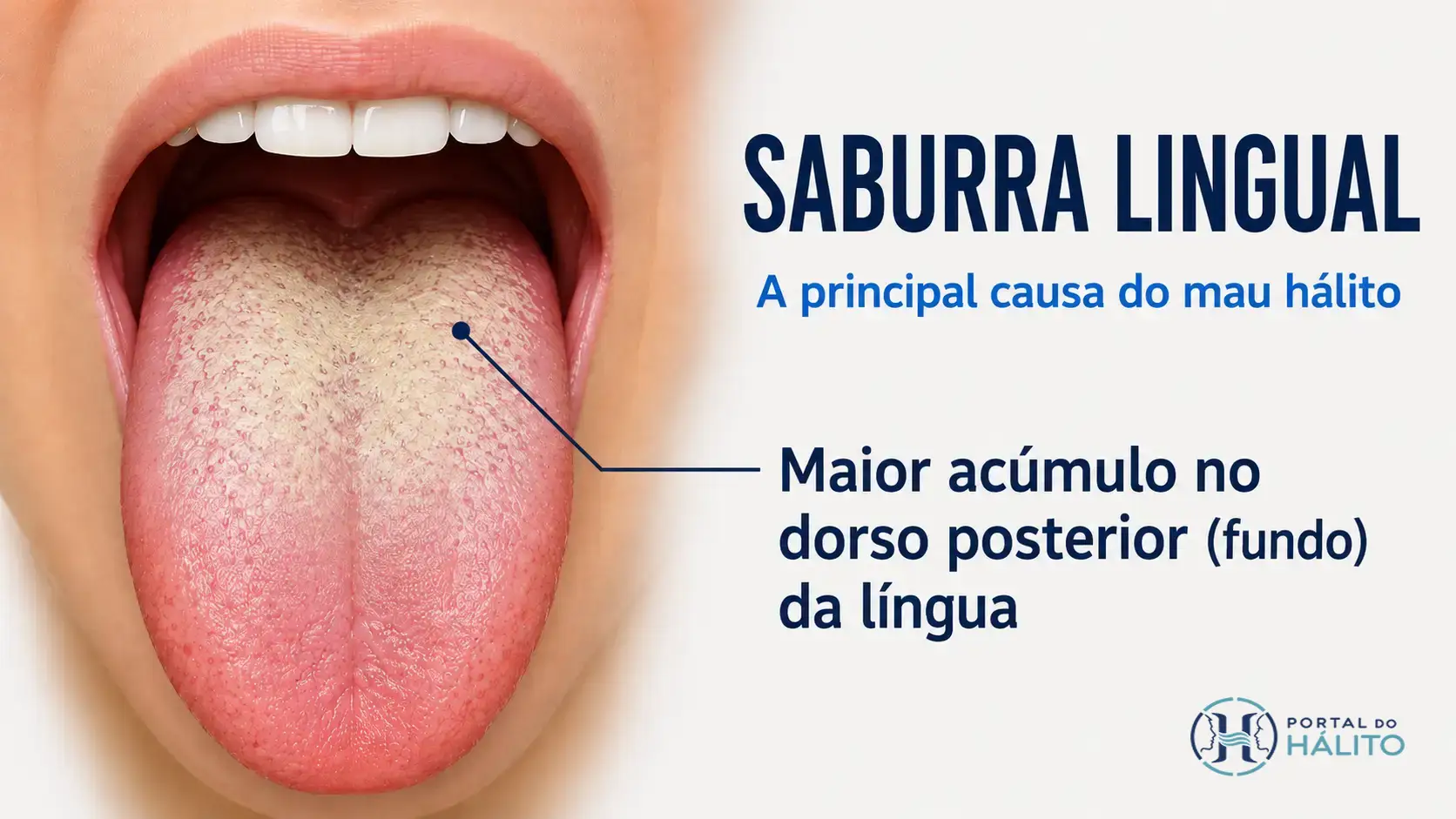 Ilustração do dorso da língua com acúmulo de saburra predominante na região posterior.