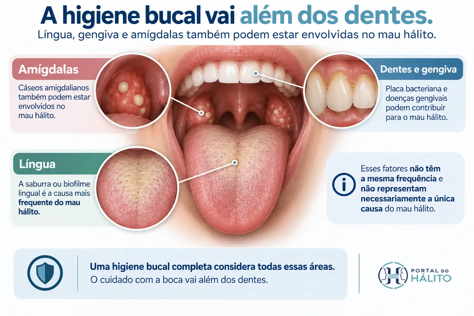 Infográfico da boca destacando língua com saburra ou biofilme lingual, dentes e gengiva com placa bacteriana e amígdalas com cáseos como fatores que podem contribuir para o mau hálito.