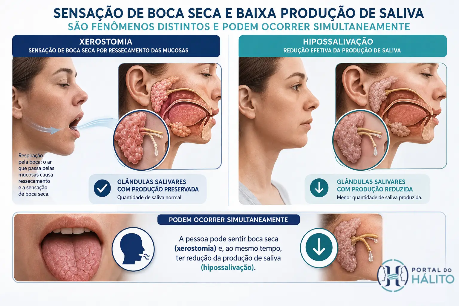 Diferença entre sensação de boca seca por respiração bucal e hipossalivação com redução da produção de saliva.